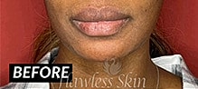 Lip Augmentation Before & After