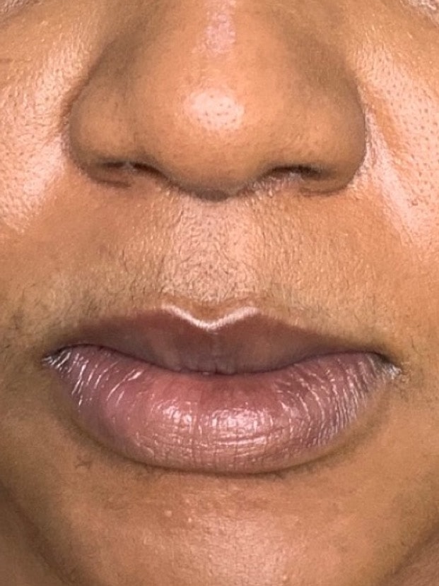 Lip Augmentation Before & After
