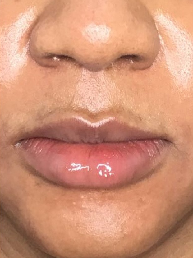 Lip Augmentation Before & After