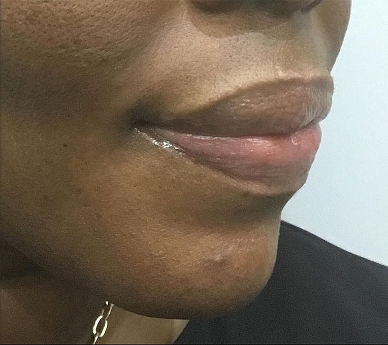 Lip Augmentation Before & After