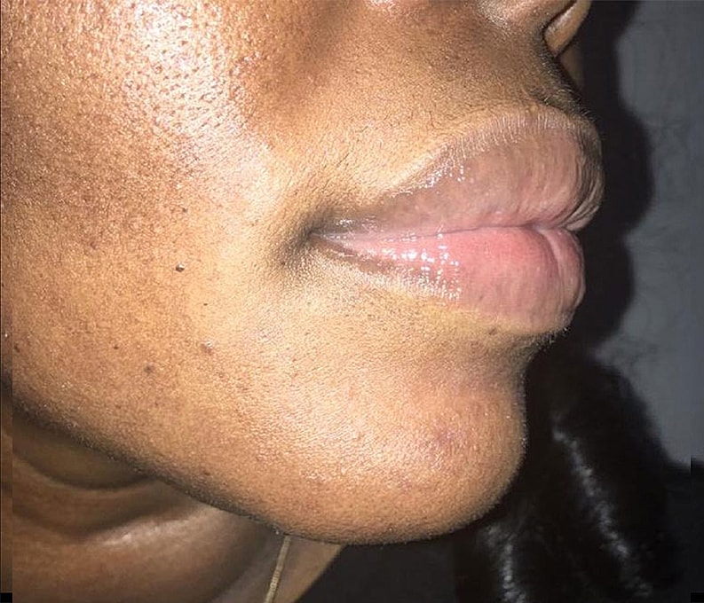 Lip Augmentation Before & After