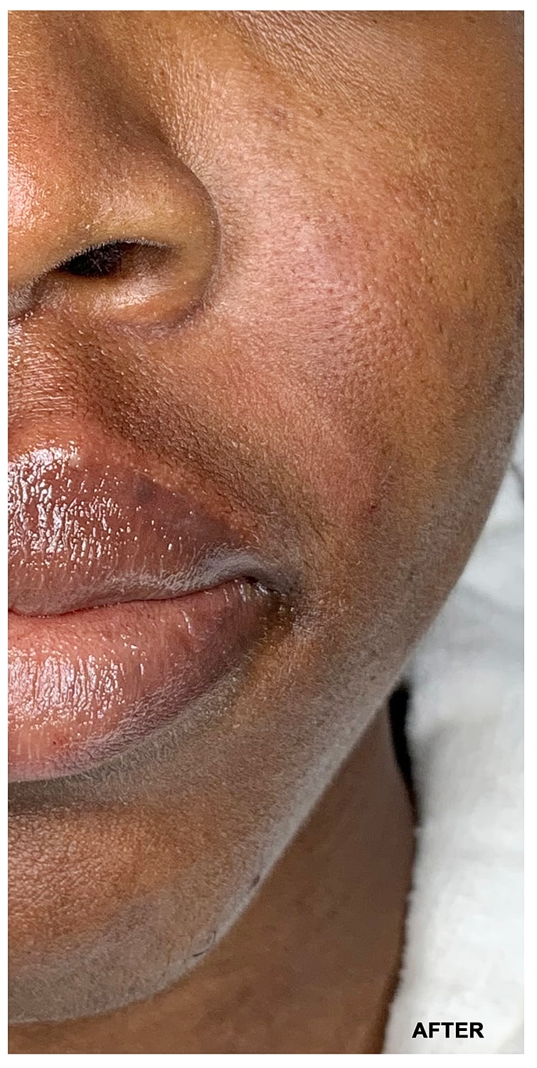 Lip Augmentation Before & After