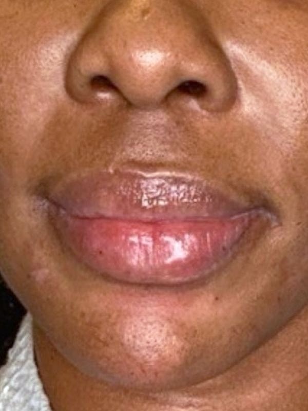 Close-up of lips and chin on darker skin.