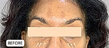 Tear Trough And Under Eye Fillers Before & After