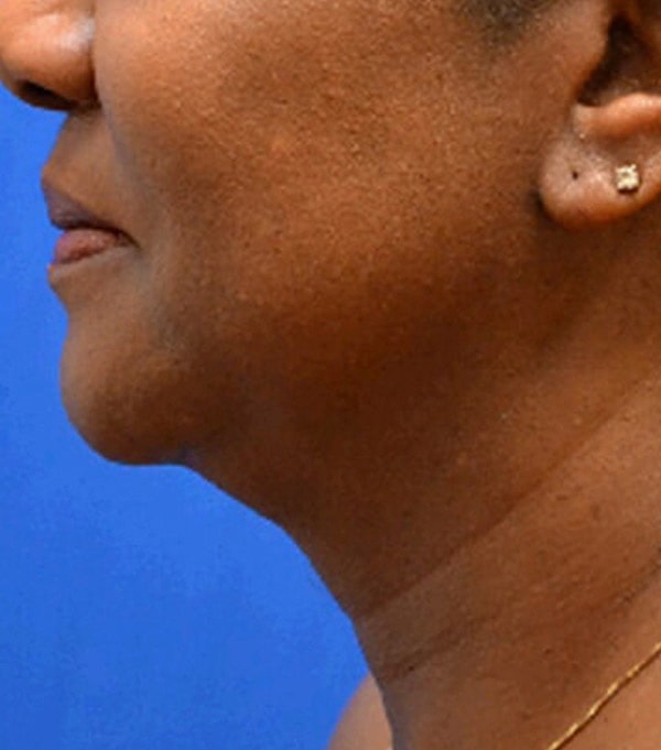 Thermineck And Thermilift Before & After