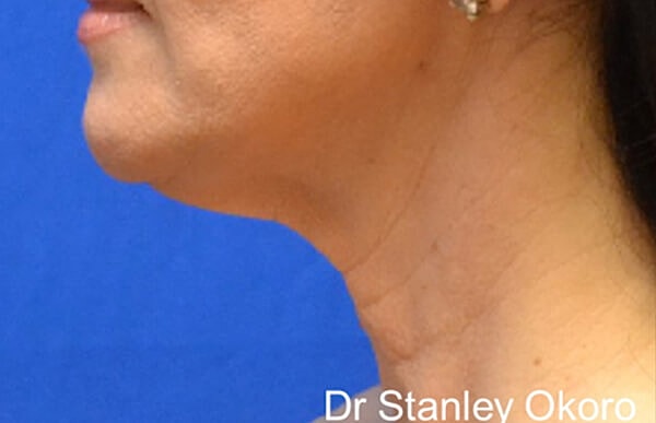 Thermineck And Thermilift Before & After