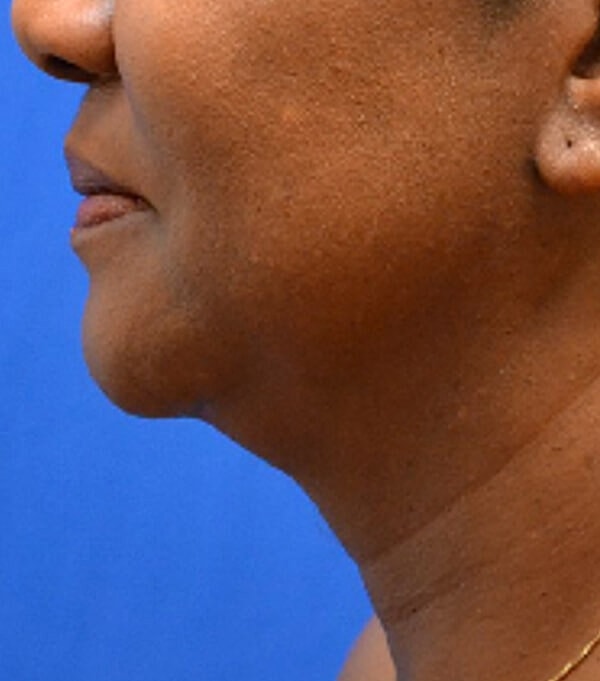 Thermineck And Thermilift Before & After