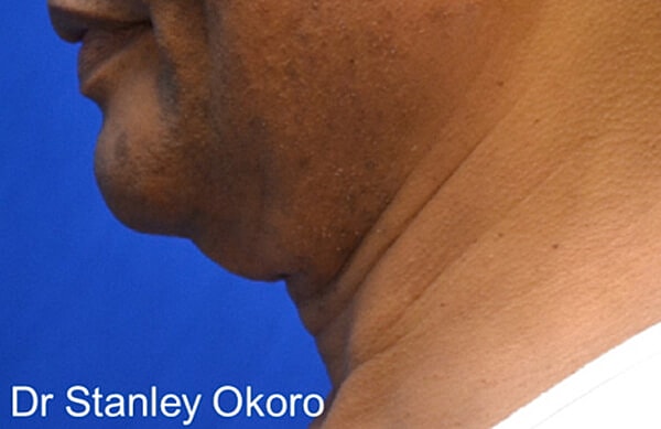 Thermineck And Thermilift Before & After