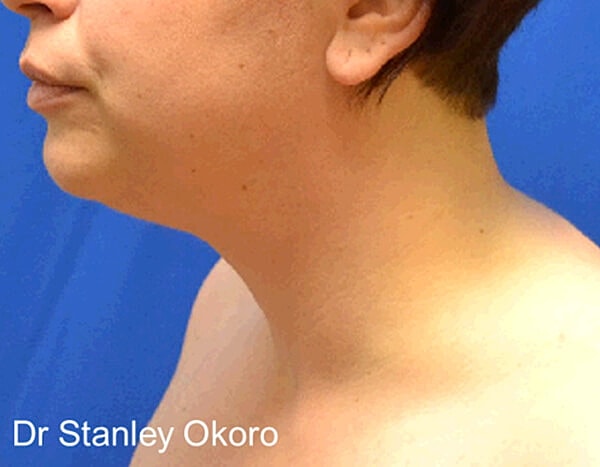 Thermineck And Thermilift Before & After