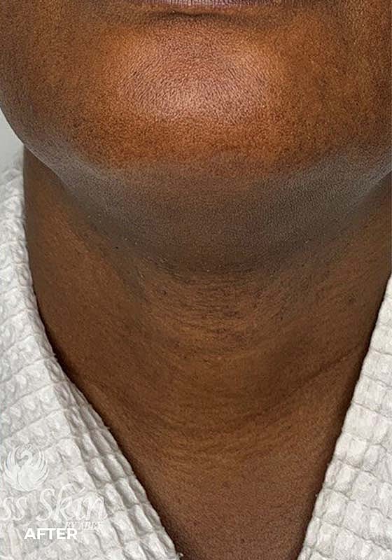 Laser Hair Removal Before & After