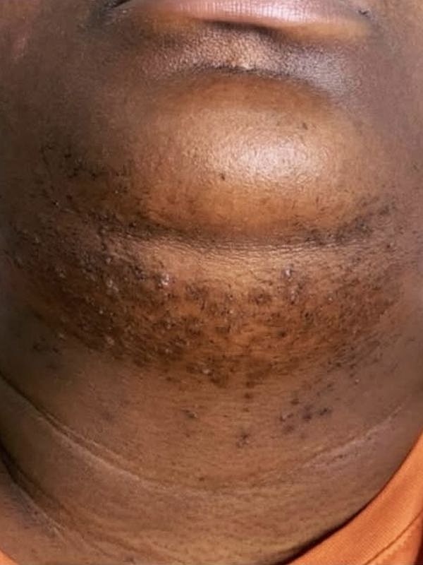 Close-up of skin with ingrown hairs and bumps.