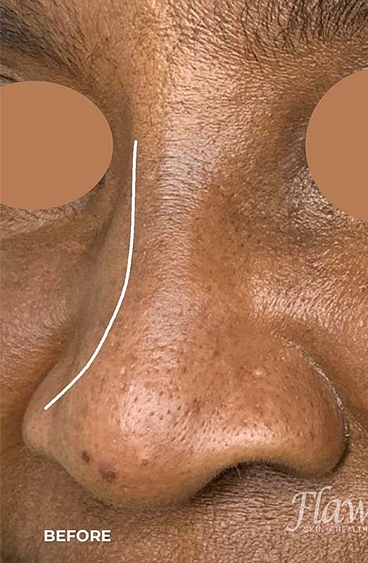 Nose Augmentation Before & After