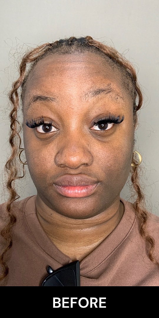 Botox Before & After