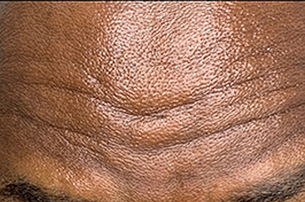 Botox Before & After