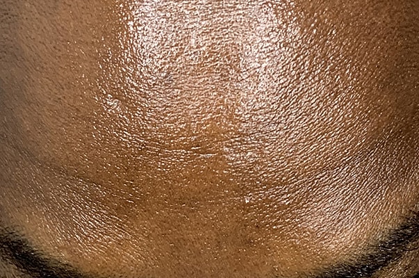 Botox Before & After