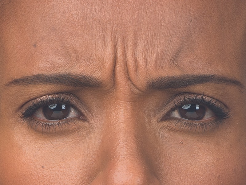 Botox Before & After