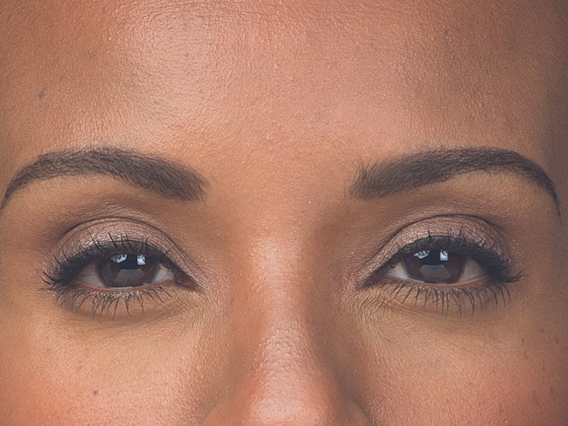 Botox Before & After