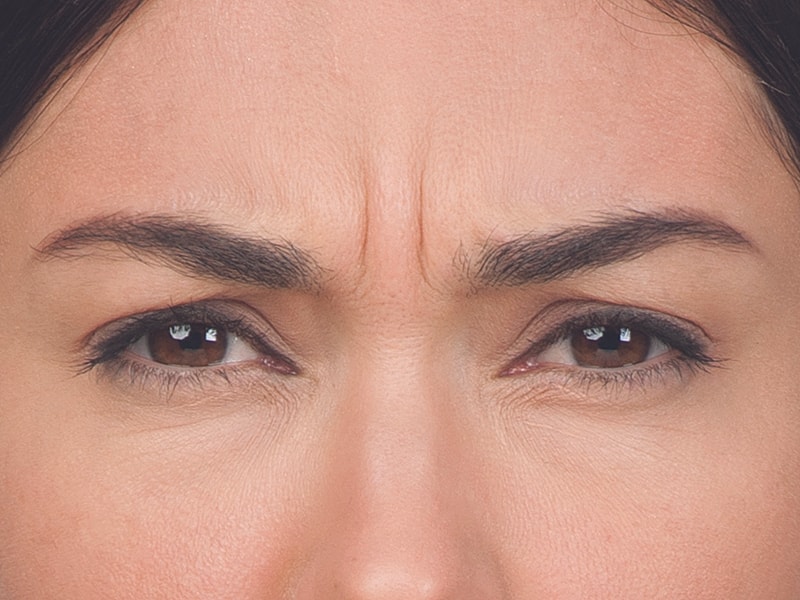 Botox Before & After