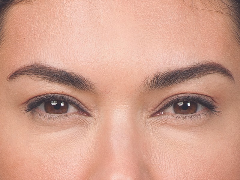 Botox Before & After