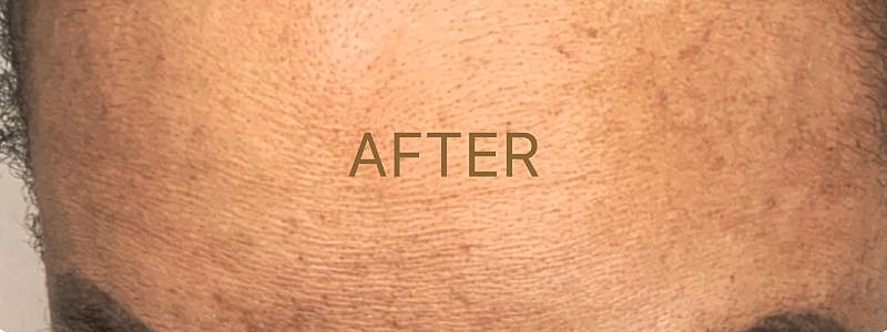 Forehead skin improvement after treatment.