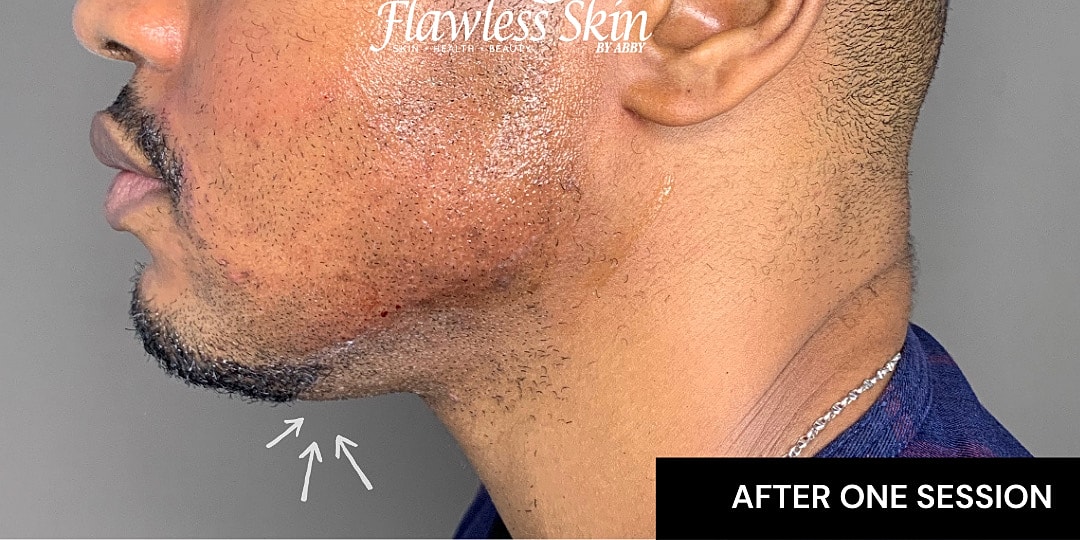 Chin Augmentation And Kybella Before & After