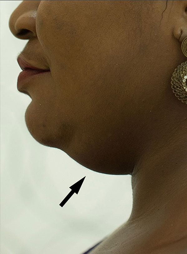 Chin Augmentation And Kybella Before & After