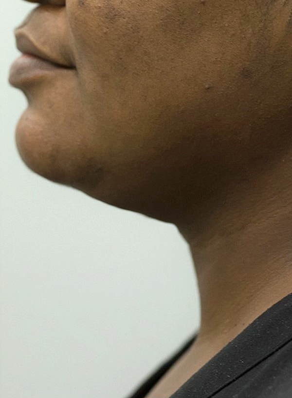 Chin Augmentation And Kybella Before & After