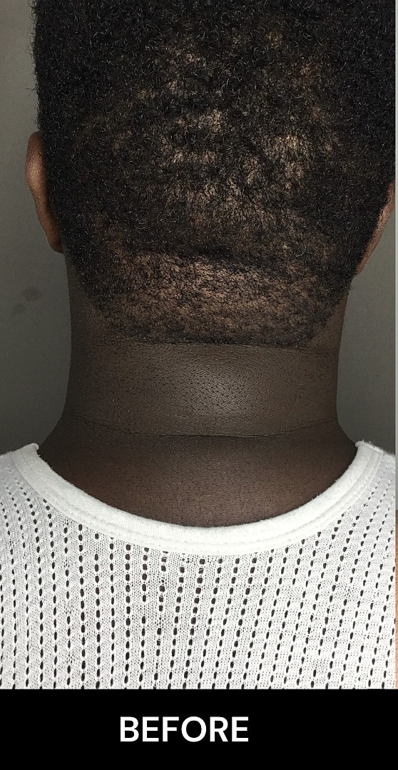 Chin Augmentation And Kybella Before & After