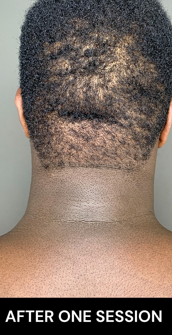 Chin Augmentation And Kybella Before & After