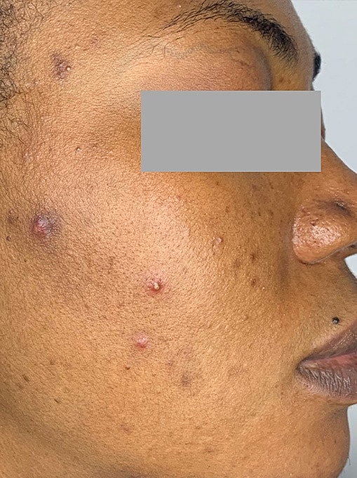 Skin Resurgacing Before & After