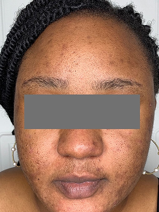 Skin Resurgacing Before & After