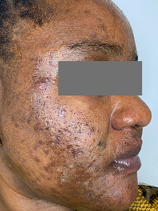 Skin Resurgacing Before & After