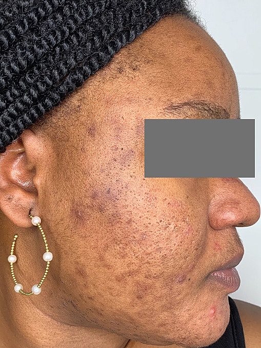 Skin Resurgacing Before & After