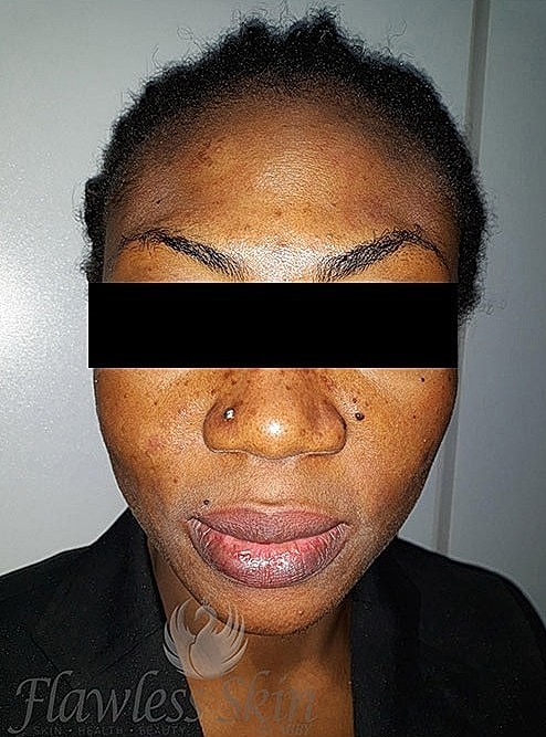 Microneedling With Prp Before & After