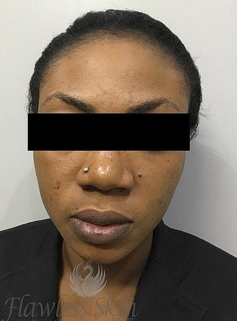Microneedling With Prp Before & After
