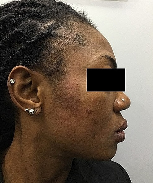 Microneedling With Prp Before & After