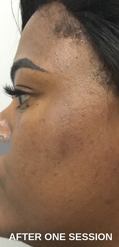 Microneedling With Prp Before & After