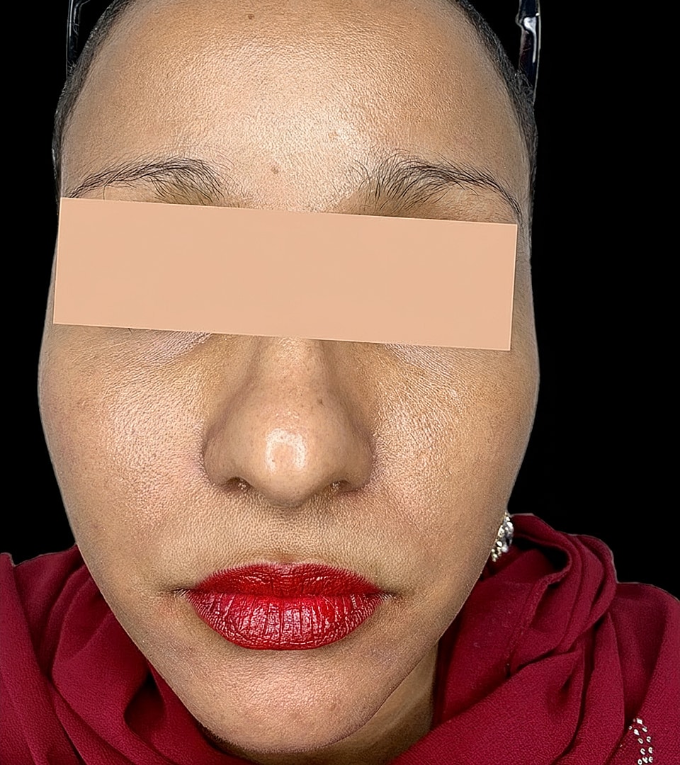 Microneedling With Prp Before & After