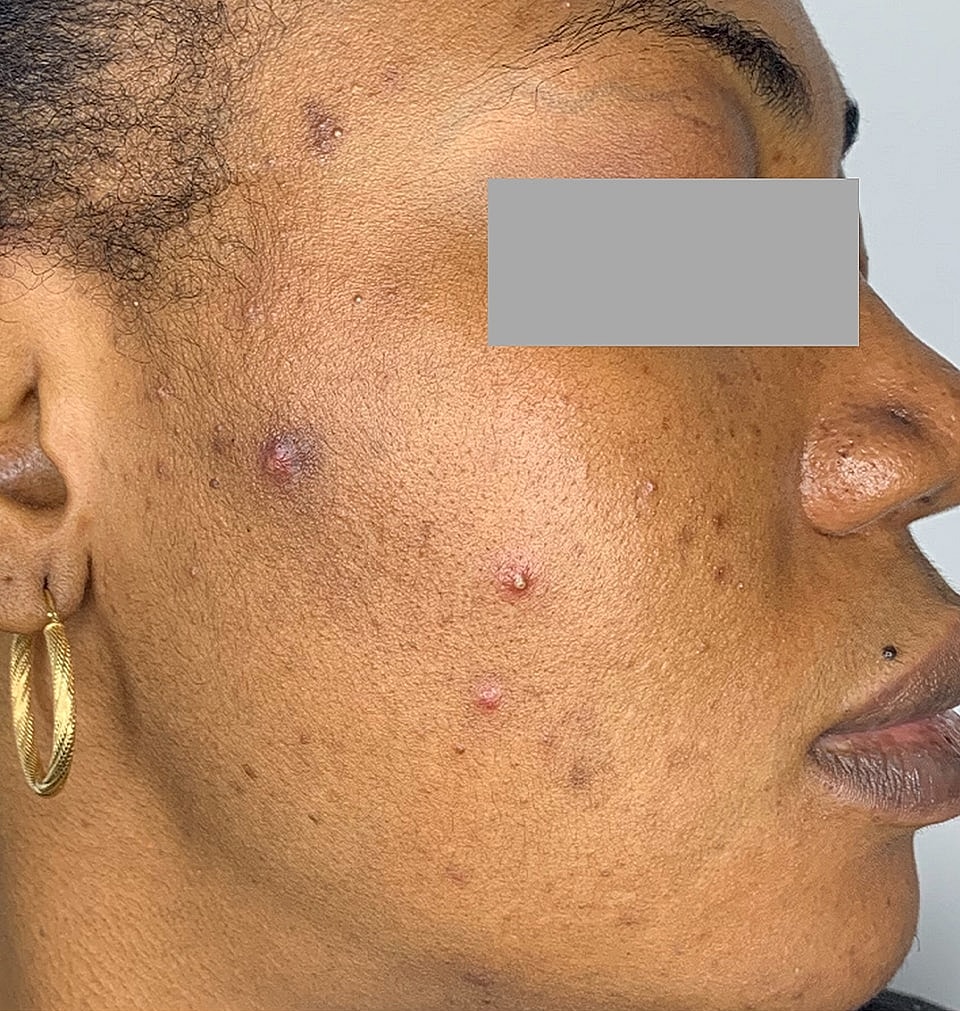 Microneedling With Prp Before & After