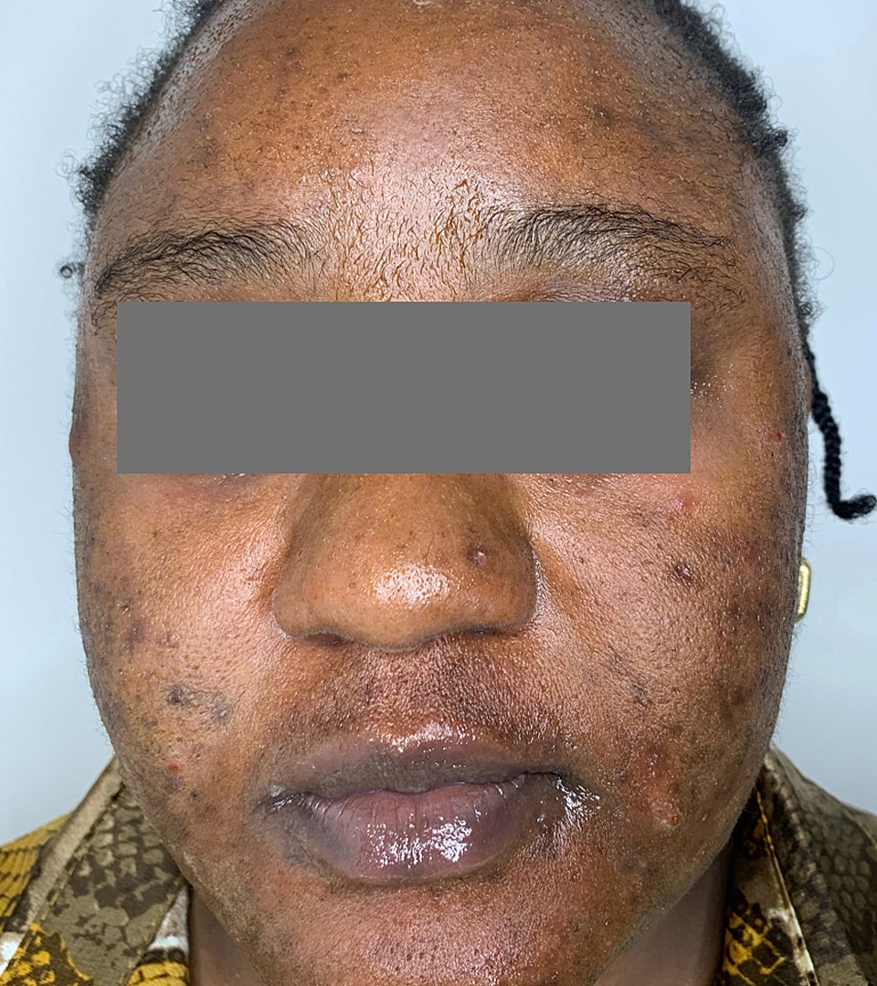 Microneedling With Prp Before & After