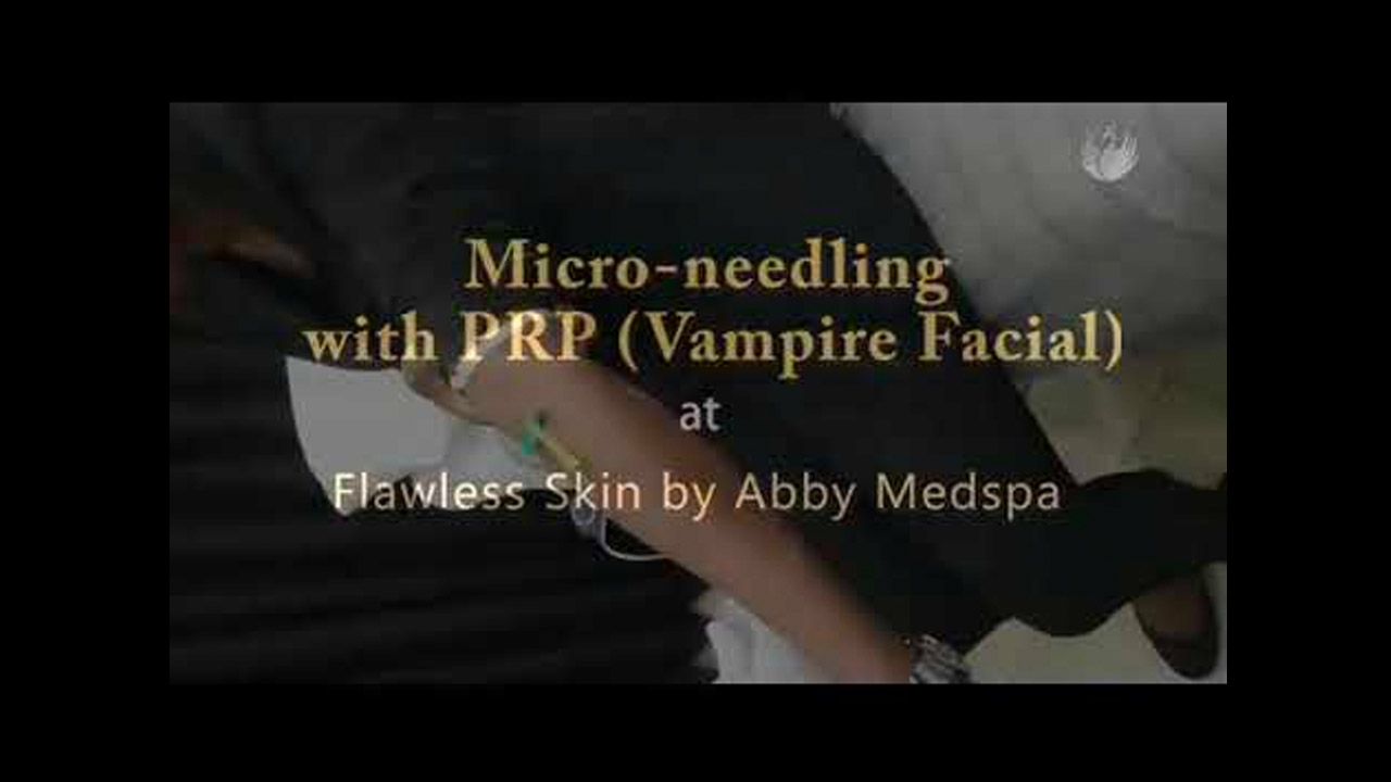 Microneedling with PRP Facial