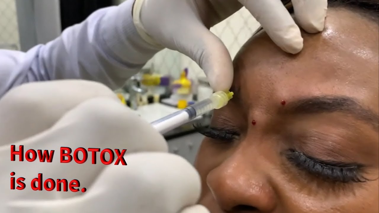 Botox Procedure