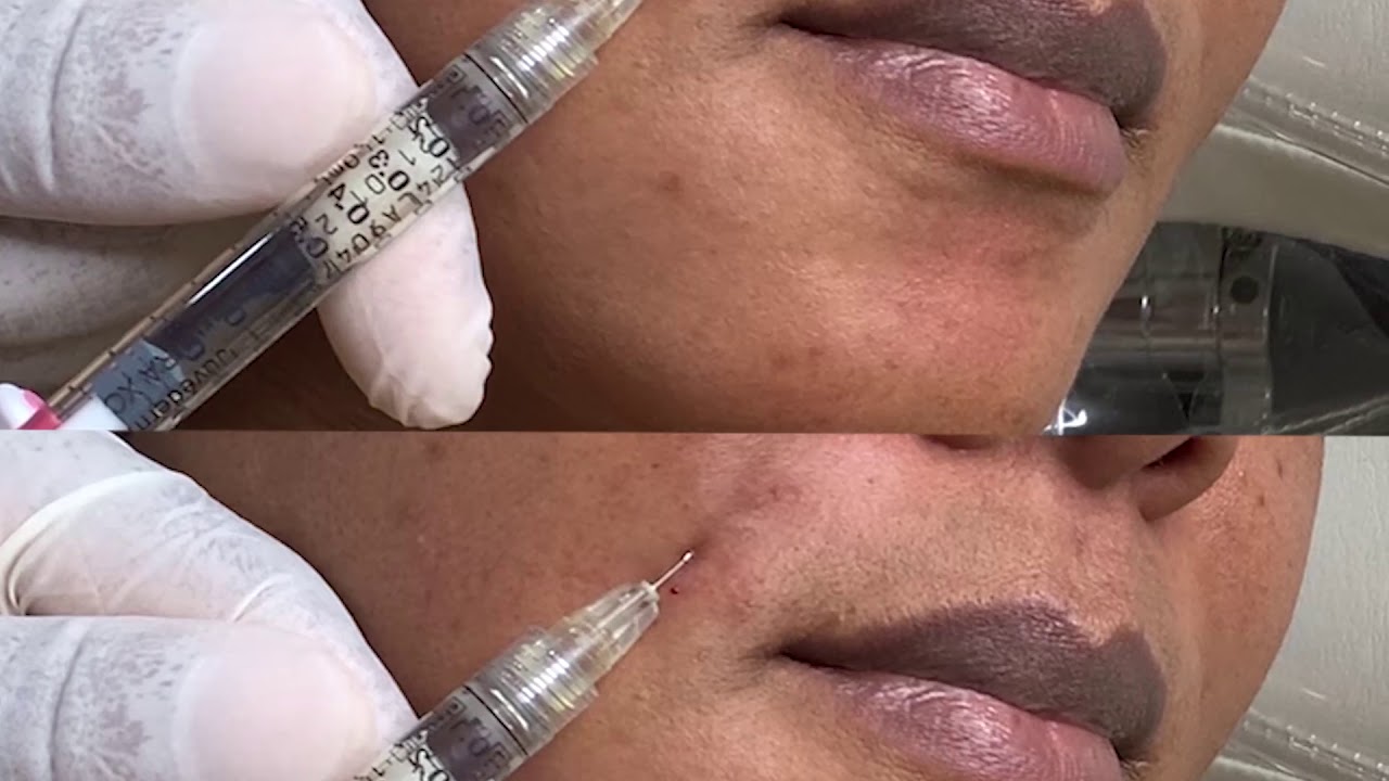 Dermal Fillers for Smile Lines