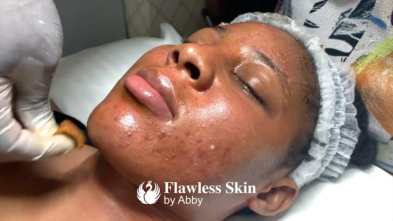 VI Peel Application for Acne