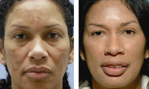 chemical peel