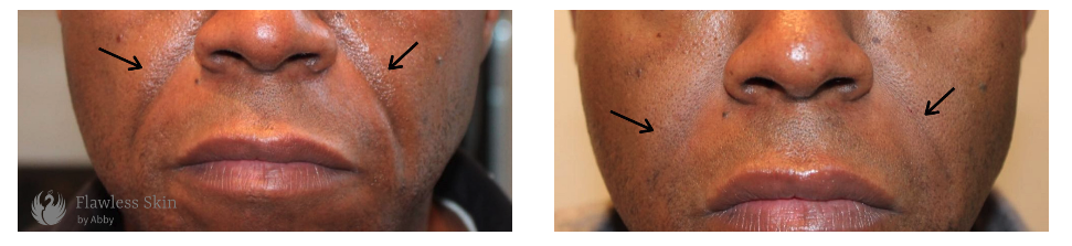 Men's Facial Filler from Flawless Aesthetic Center in Abuja