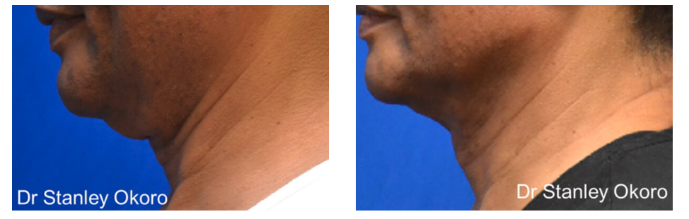 Men's Double Chin Reduction in Abuja
