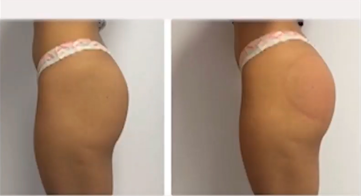 Non-Surgical Butt Lift Abuja