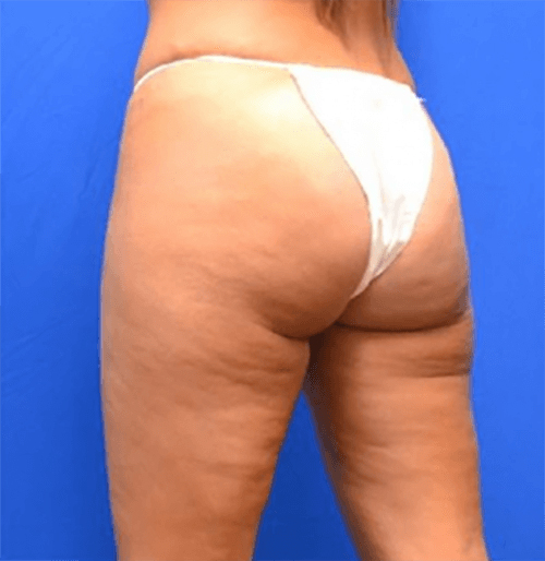 Brazilian Butt Lift Before and After | Flawless Aesthetic Center