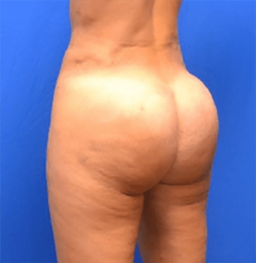 Brazilian Butt Lift Before and After | Flawless Aesthetic Center